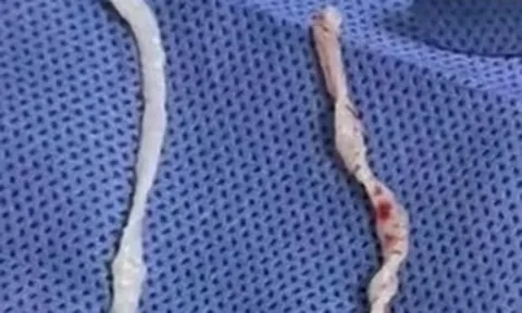 Đau cánh tay suốt một năm, người phụ nữ bàng hoàng khi bác sĩ phát hiện hai sinh vật dài 10cm đang sống dưới da