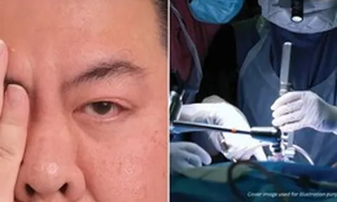 Tin vào mẹo dân gian trên mạng để giải xui khi nháy mắt phải, người đàn ông suýt mù vĩnh viễn vì bị bong võng mạc