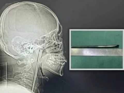 Người đàn ông sống 8 năm với chiếc đũa trong cổ họng và cái kết khiến cộng đồng mạng không thể tin nổi