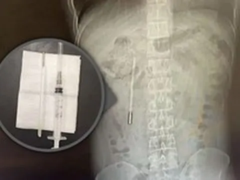 Đi viện vì đau dạ dày, người đàn ông bất ngờ phát hiện chiếc nhiệt kế thủy ngân nằm trong bụng suốt hai mươi năm