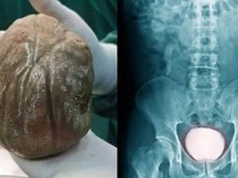 Người đàn ông chịu đau đớn suốt 3 năm vì tiểu buốt, tới viện mới phát hiện viên sỏi nặng hơn 1kg trong bàng quang