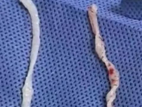 Đau cánh tay suốt một năm, người phụ nữ bàng hoàng khi bác sĩ phát hiện hai sinh vật dài 10cm đang sống dưới da